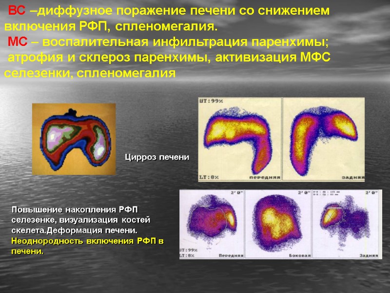 ВС –диффузное поражение печени со снижением включения РФП, спленомегалия.  МС – воспалительная инфильтрация